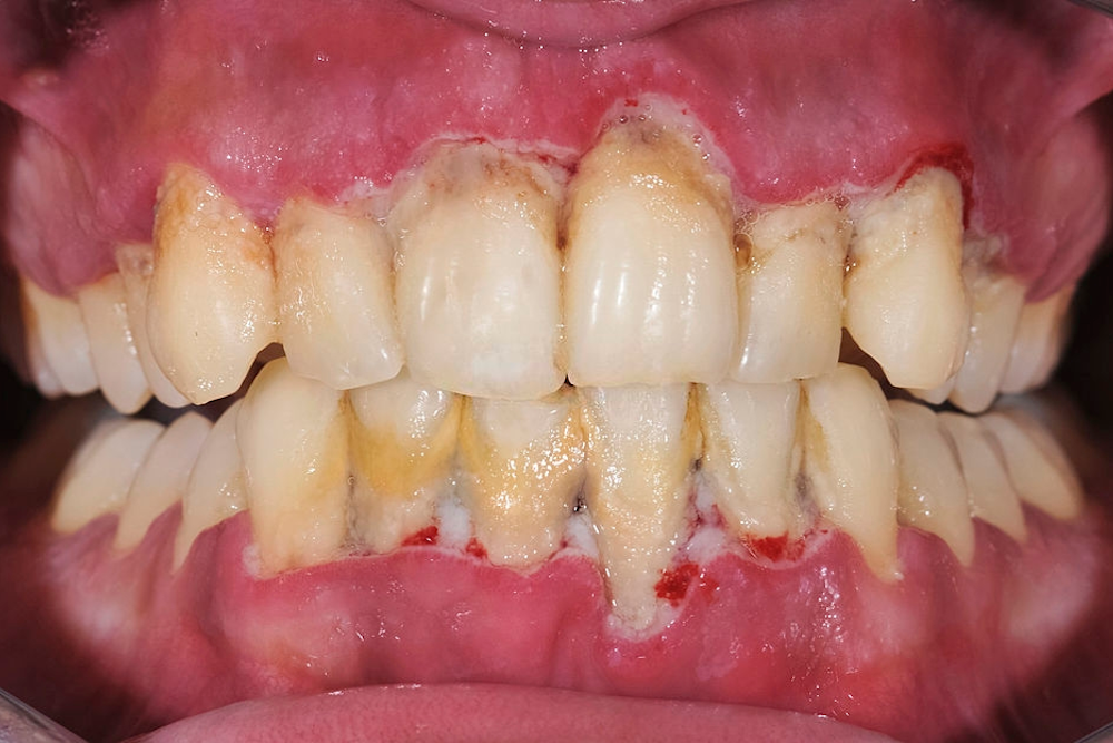 Conheça As Principais Doenças Bucais E Evite As Maisodonto 5797