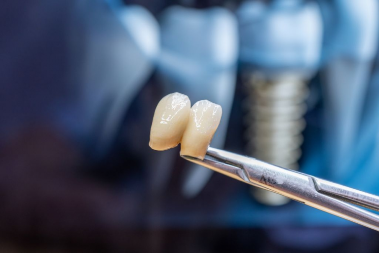 Coroa Dentária O que é, como funciona e cuidados MaisOdonto