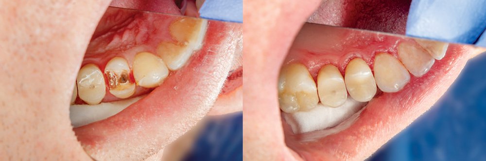 como e feita a restauração de um dente