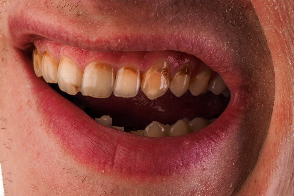 Featured image of post Imagens De Dente Estragado - La búsqueda de imágenes más completa de la web.