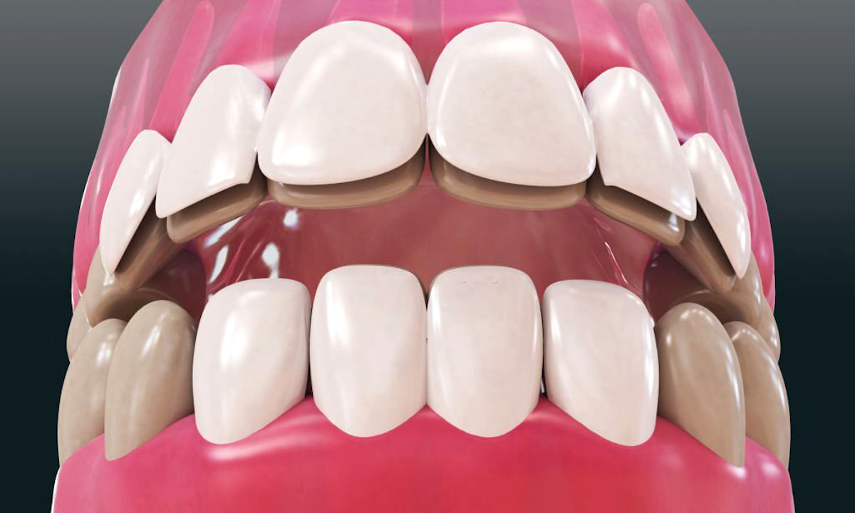 Faceta dental quem é mais indicado para este tratamento