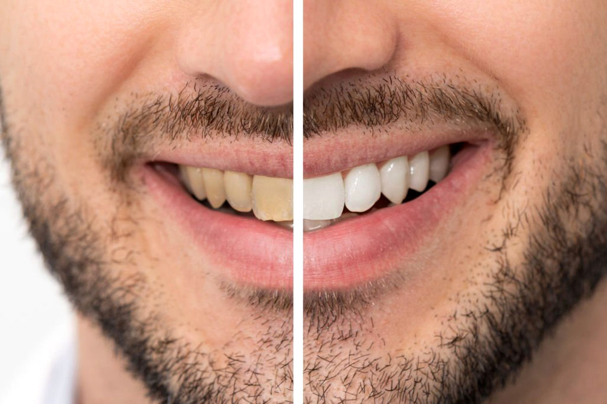 Como para manter os dentes brancos ou mais brancos?