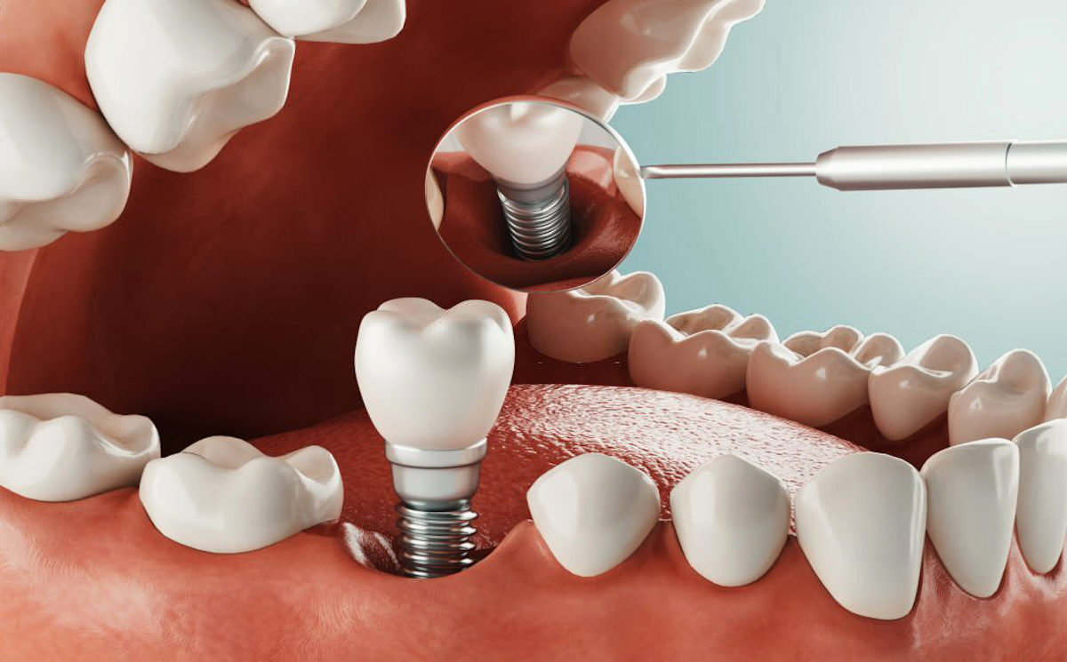corrigir a perda de dentes com implante dentário