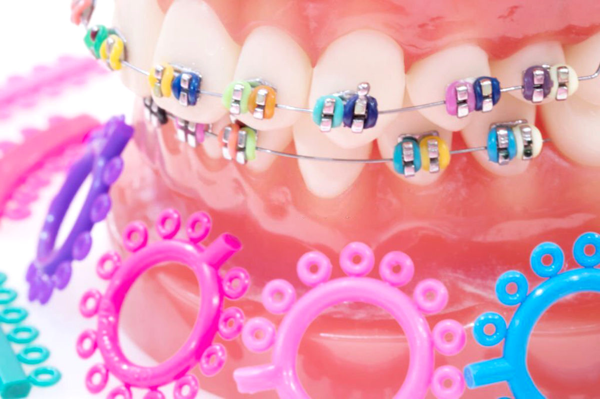 Como personalizar cores dos elásticos de aparelhos odontológicos