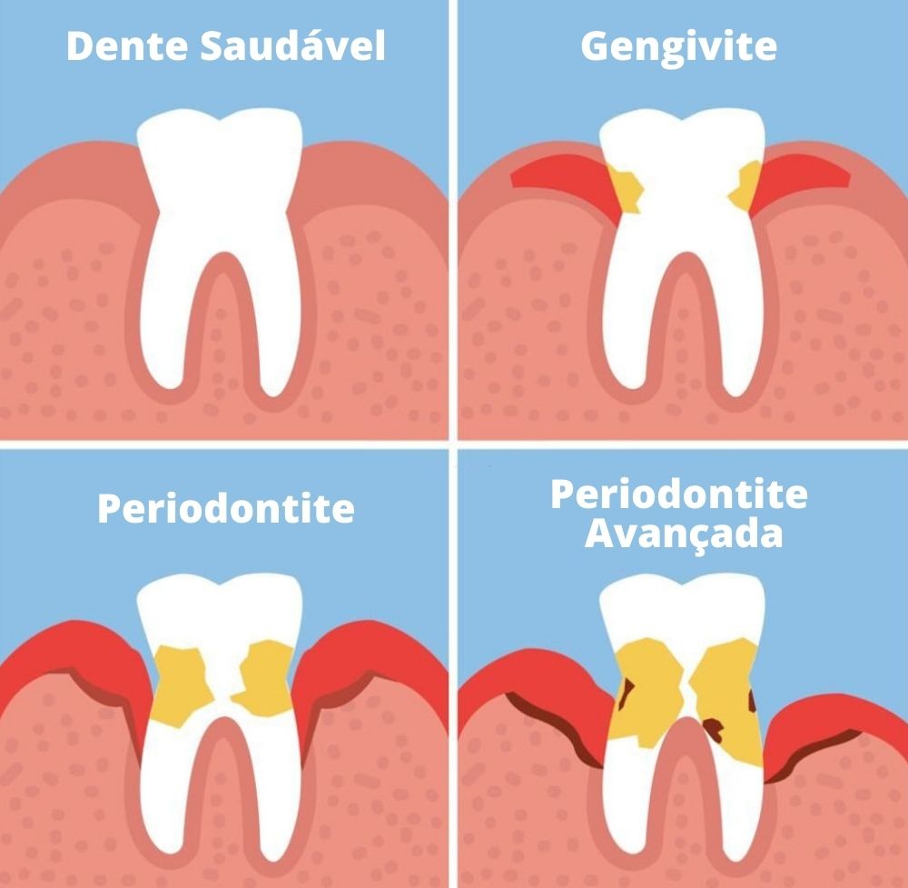 tratar uma gengivite que evoluiu periodontite