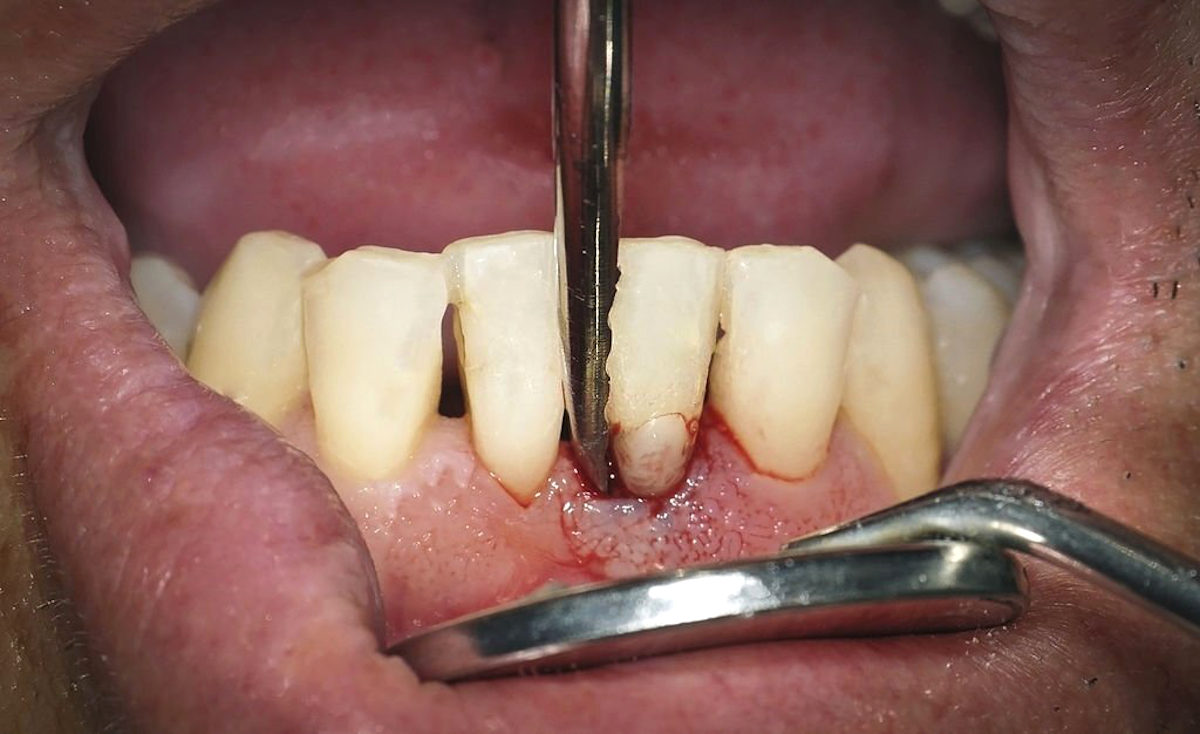 Exposição da raiz e retração da gengiva na periodontite