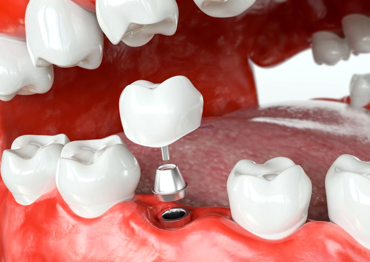 Implantes dentários para corrigir perda de dentes