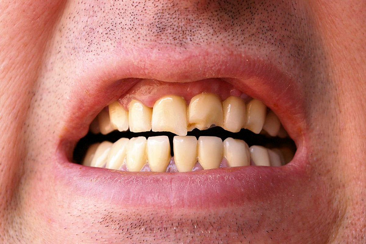 Odontologia estética por vaidade ou restauração