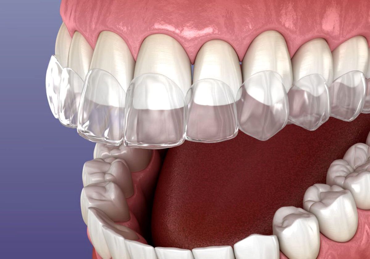 Contenção dentária móvel transparente