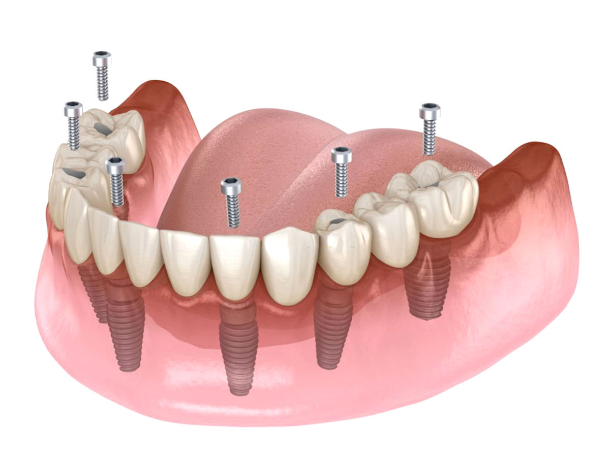 implantes mantêm os dentes próximos no lugar