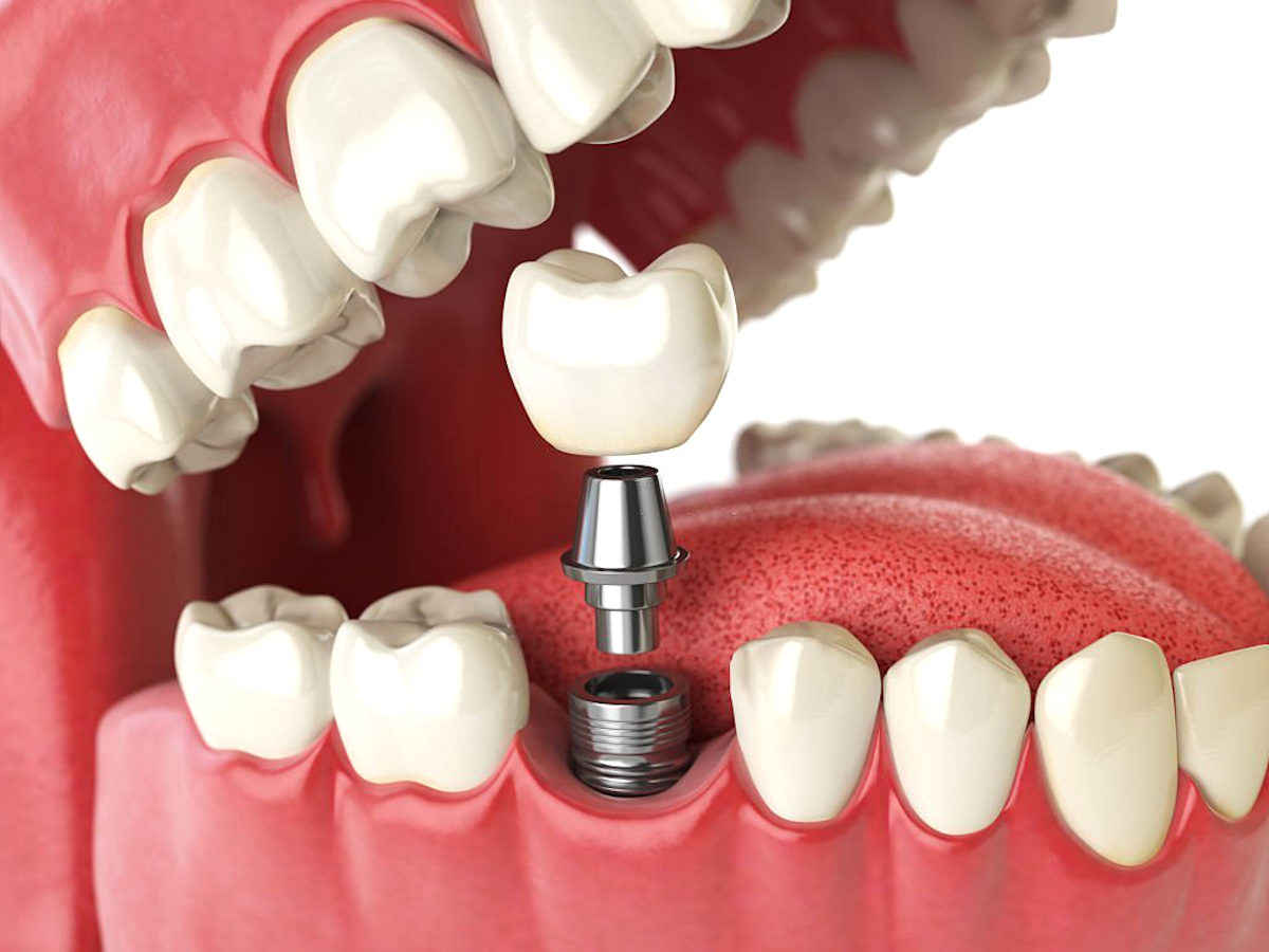Sete vantagens dos implantes dentários