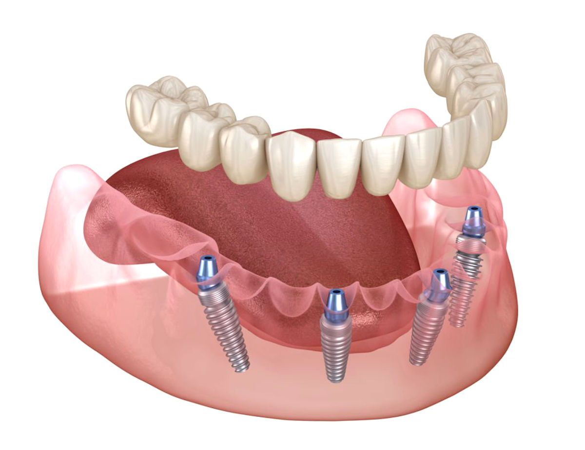 como é procedimento de implante de dentes?