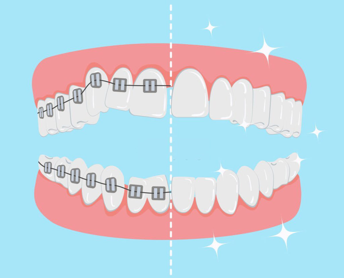 Ortodontia estética para melhorar a função e beleza dos dentes