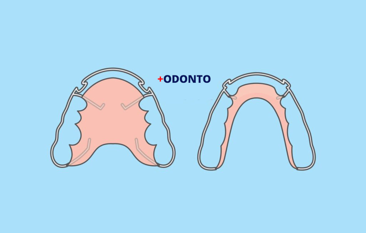 Sem retentor ou contenção dental os dentes podem se mover