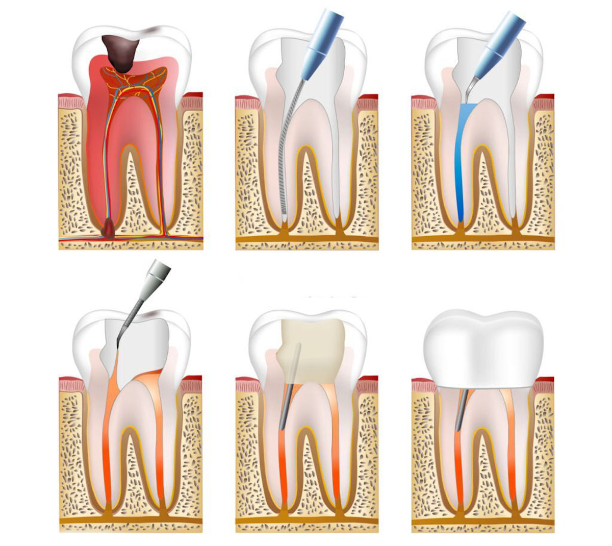 Tratamento endodôntico para preservar dente natural