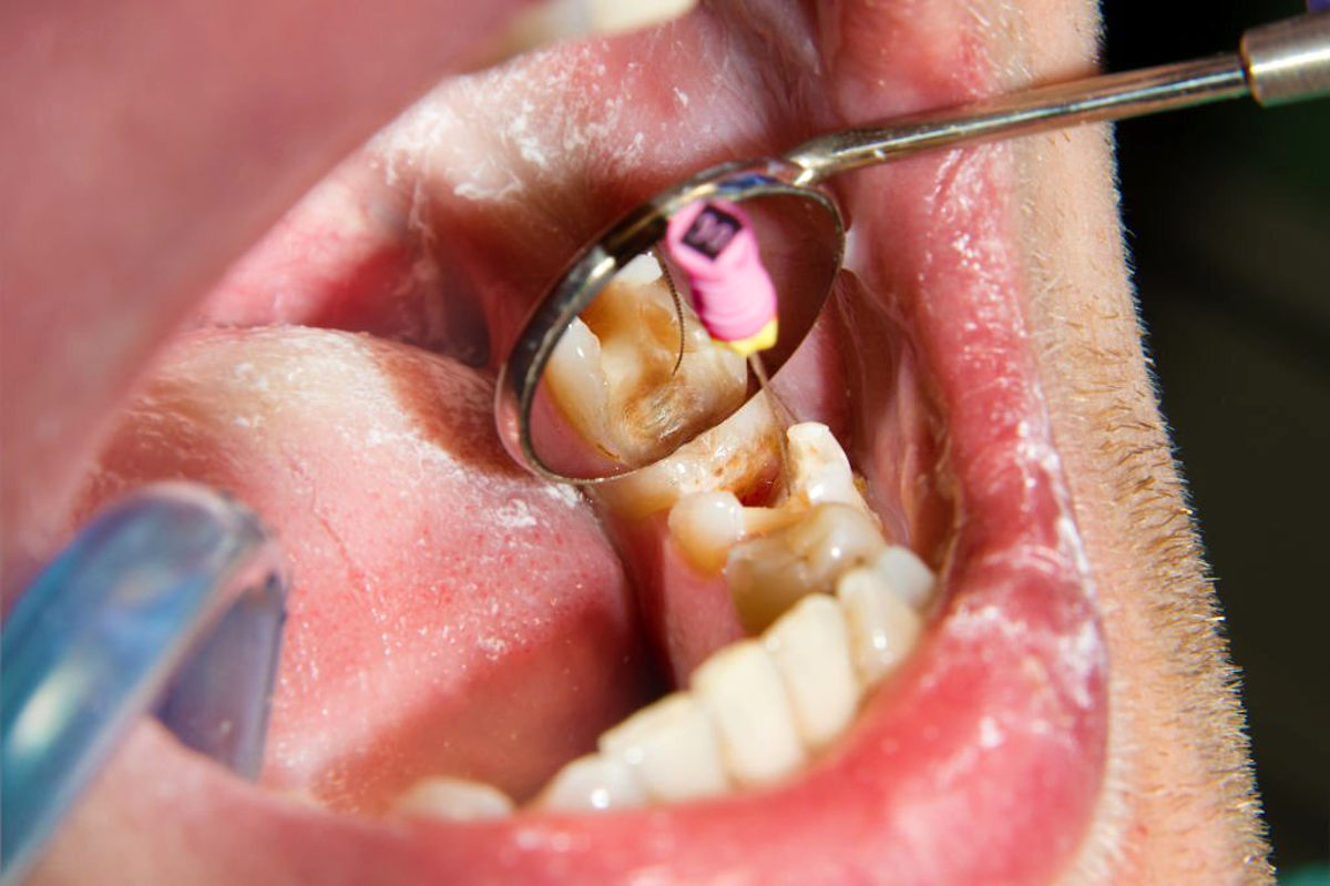 tratamento endodôntico para preservar o dente